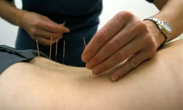 Sprains and Acupuncture: Can It Help with Pain and Recovery?